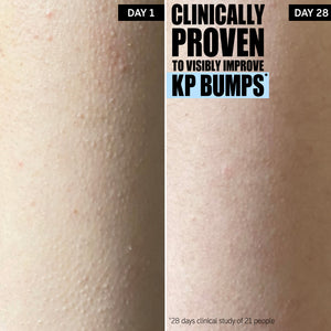 Clinically proven to visibly improve KP bumps*. Progress after 28 days of use.
