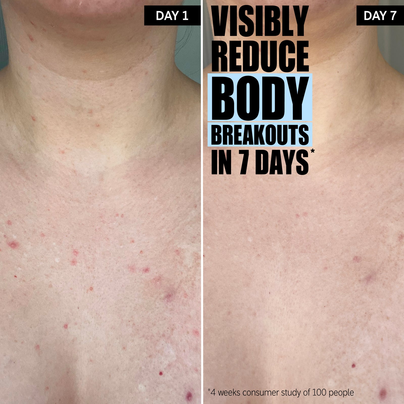Visibly reduces body breakouts in 7 days*. Progress after 7 days.