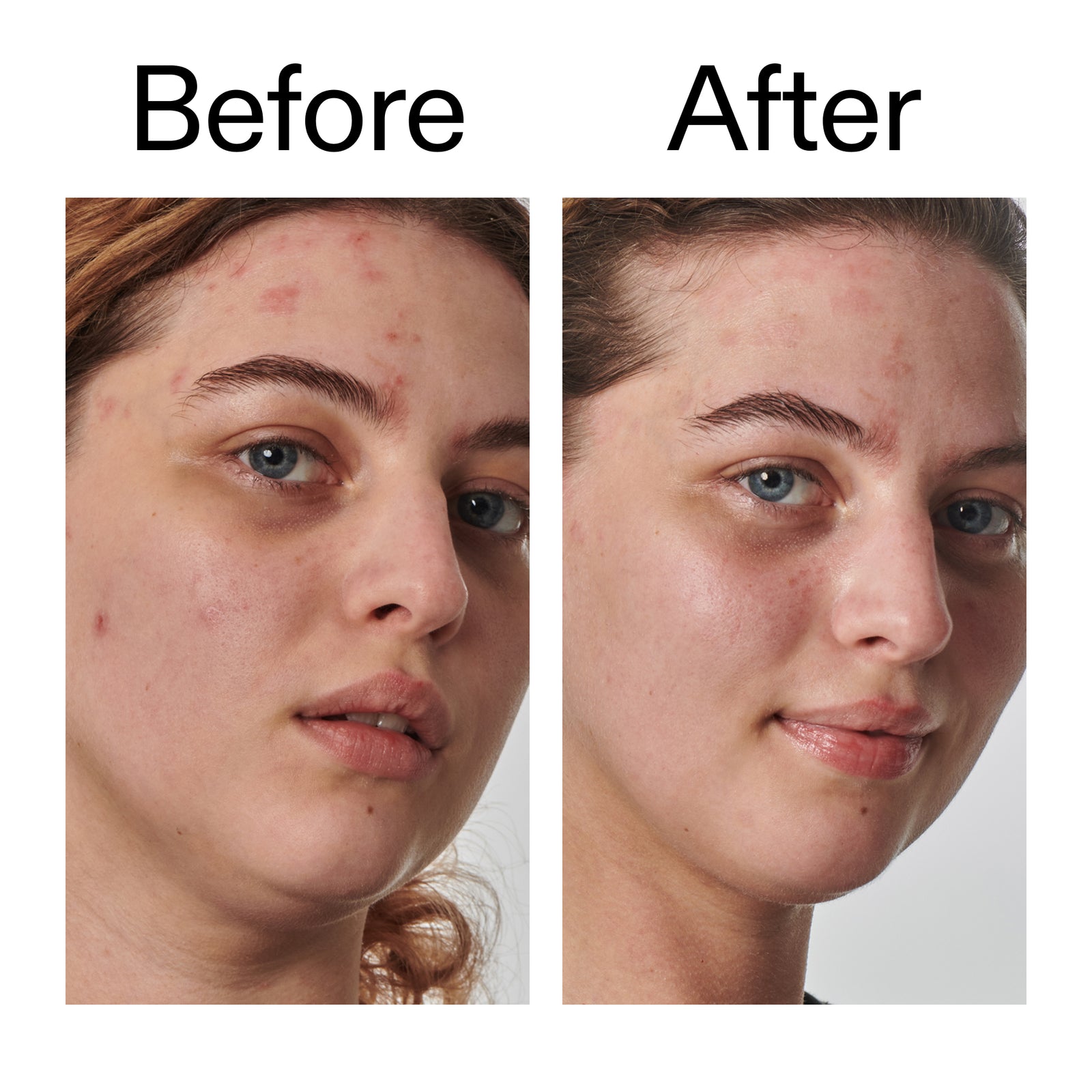 Before and after comparison of a person's face with visible acne on the left and clearer skin on the right.