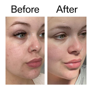 Before and after comparison of a person's face with visible skin improvement when using Omega Water Cream