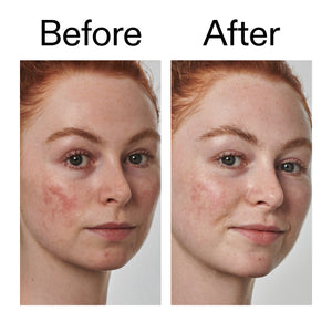 Before and after comparison of a person's face with visible skin improvement.