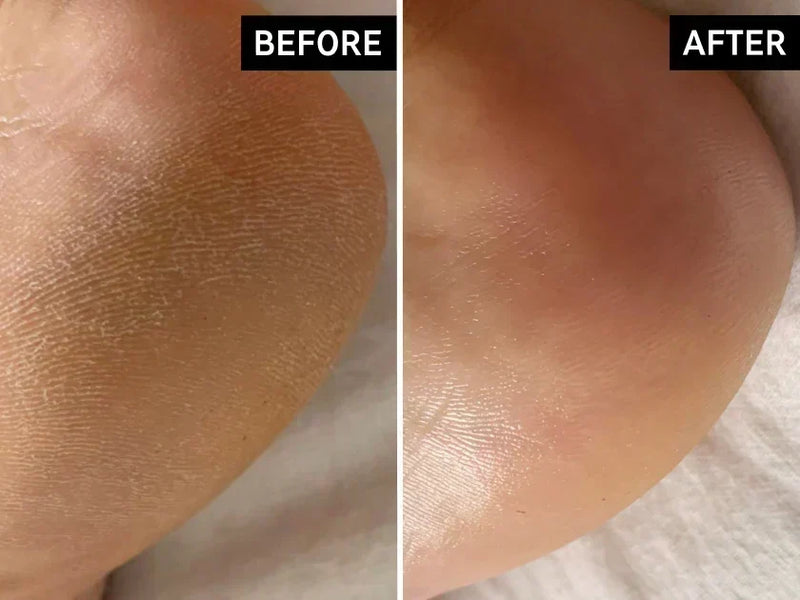before and after of cracked heels