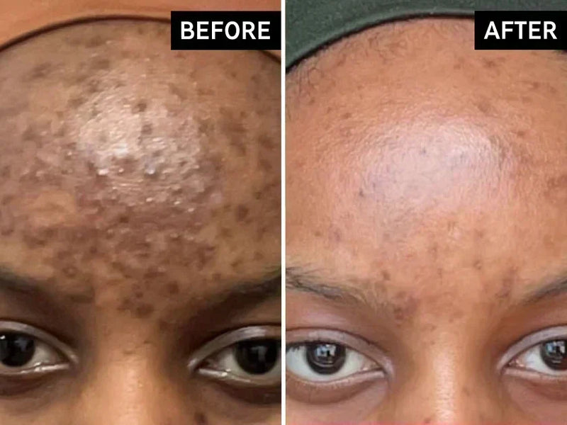 before and after using tranexamic acid