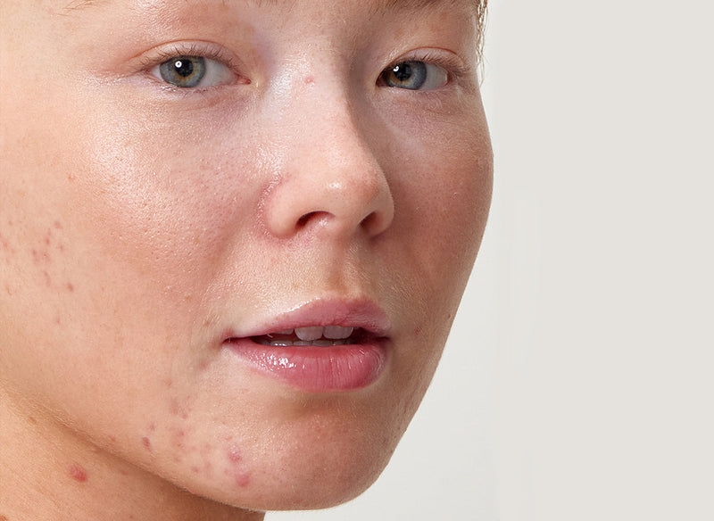 Model with acne on chin