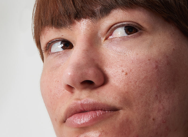 Model with acne