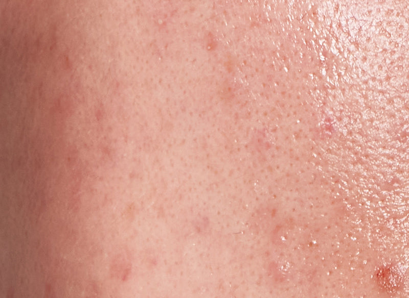Close up of acne prone skin