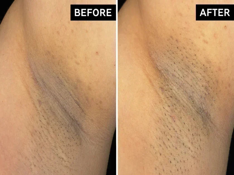 before and after armpit discoluration