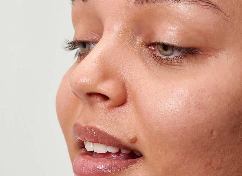 Hyperpigmentation 101 blog cover model shot