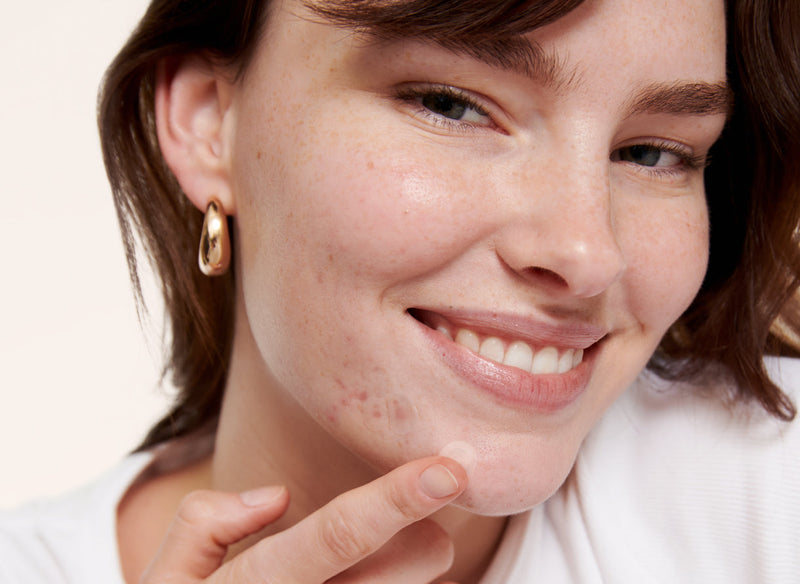 What Are Blemishes?