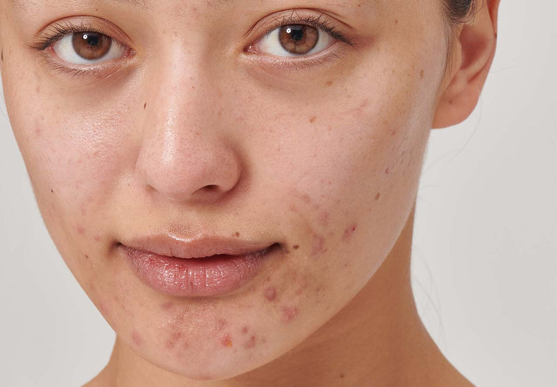 Model with acne on her chin