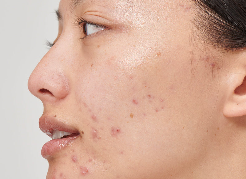 Model with acne on her cheek