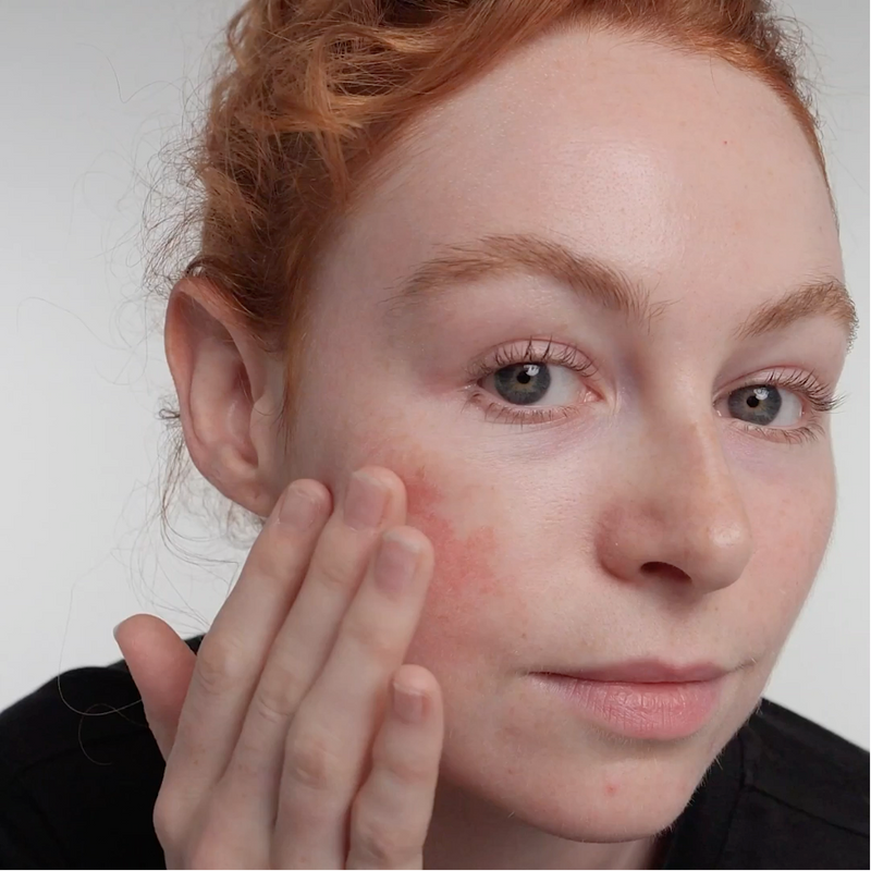 Woman with rosecea
