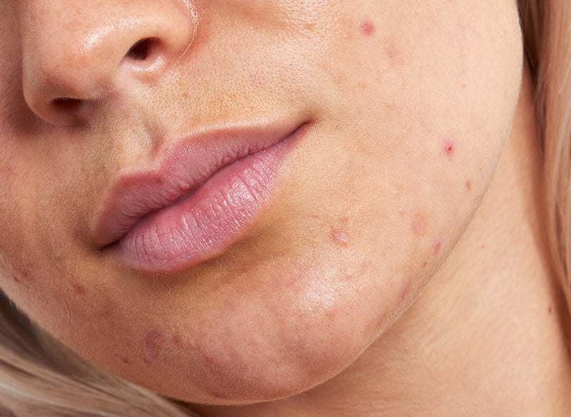 Woman with acne on her chin