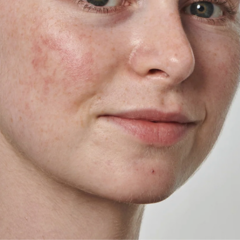 How to Reduce and Prevent Redness