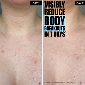 Visibily reduces body breakouts in 7 days* *4 week consumer study of 100 people