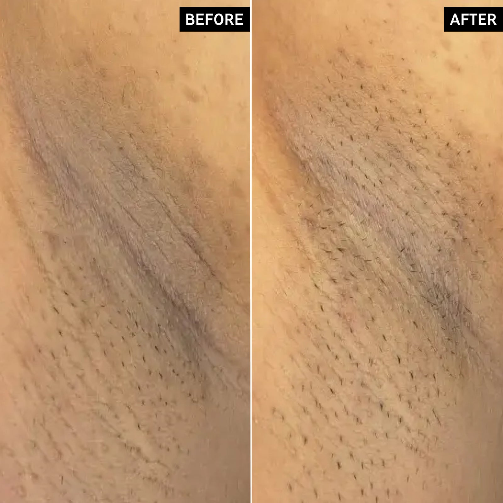 Before and after using Glycolic Body Stick on armpit showing discoloration improved