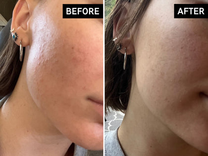 Before and after comparison of a person's neck skin texture with earrings.