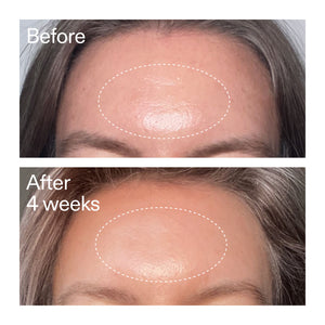 Before and after comparison of a skin treatment on a person's forehead.