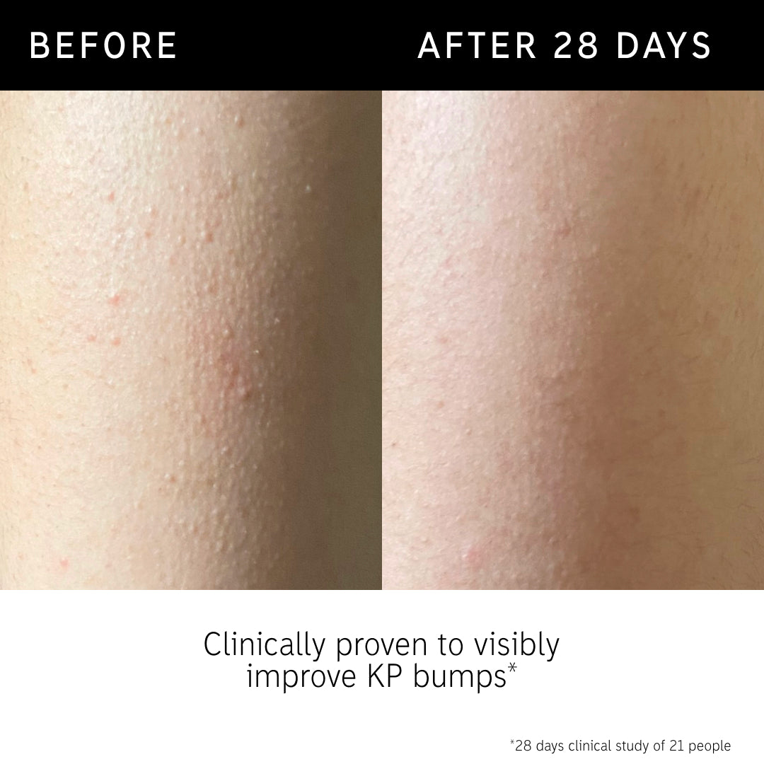 Before and after using Glycolic body stick and key claim from clinical study