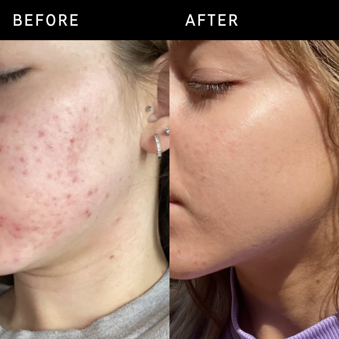 Before and after using Niacinamide Serum