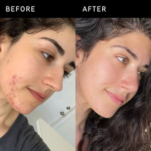 Before and after using Succinic Acid Treatment