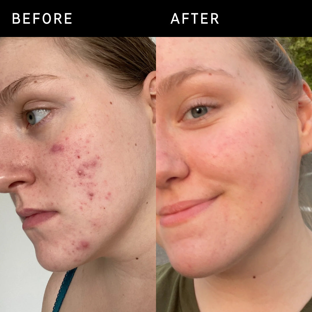 Before and after using 15% Vitamin C & EGF Serum