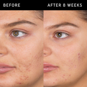 Before and after using salicylic acid cleanser