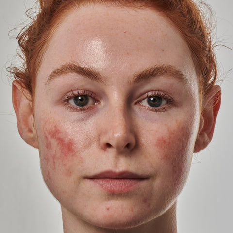 Model with irritated skin on her cheeks