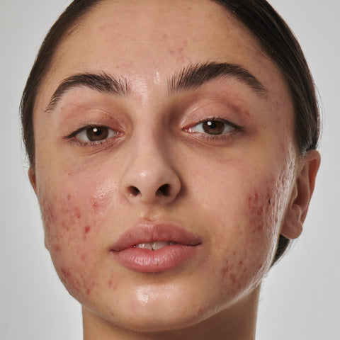 Model with acne scarring on her face