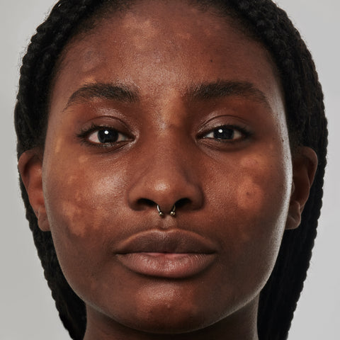 Model with very dry skin