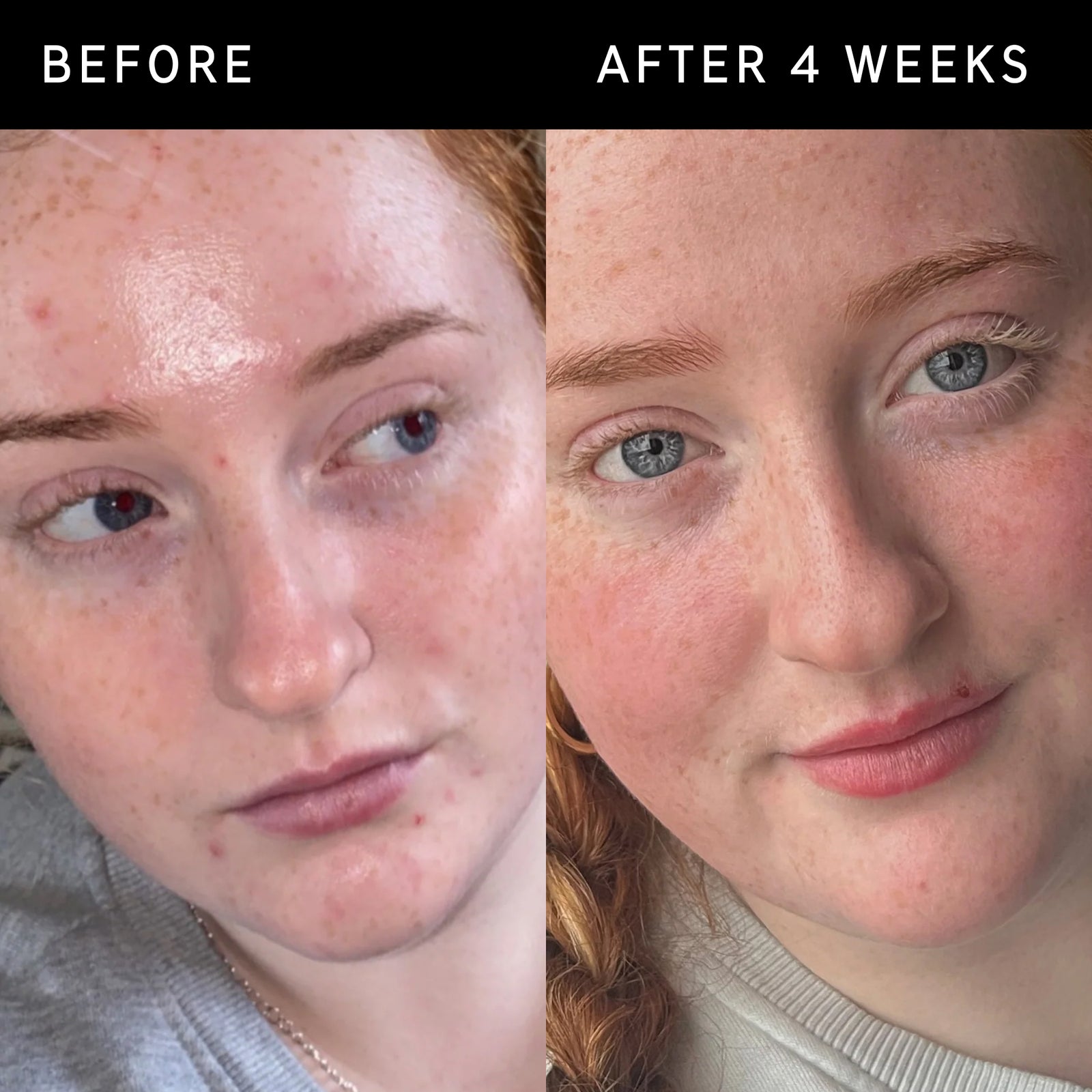 Before and after using Vitmamin B C E Moisturizer after 4 weeks