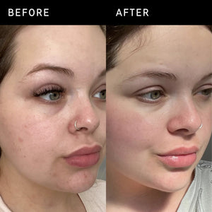 Before and after showing reduced redness and even skin tone 