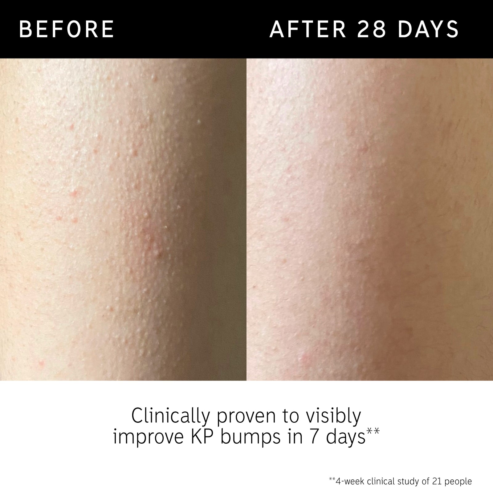 Before and after using Glycolic Body Stick for 28 days for KP bumps