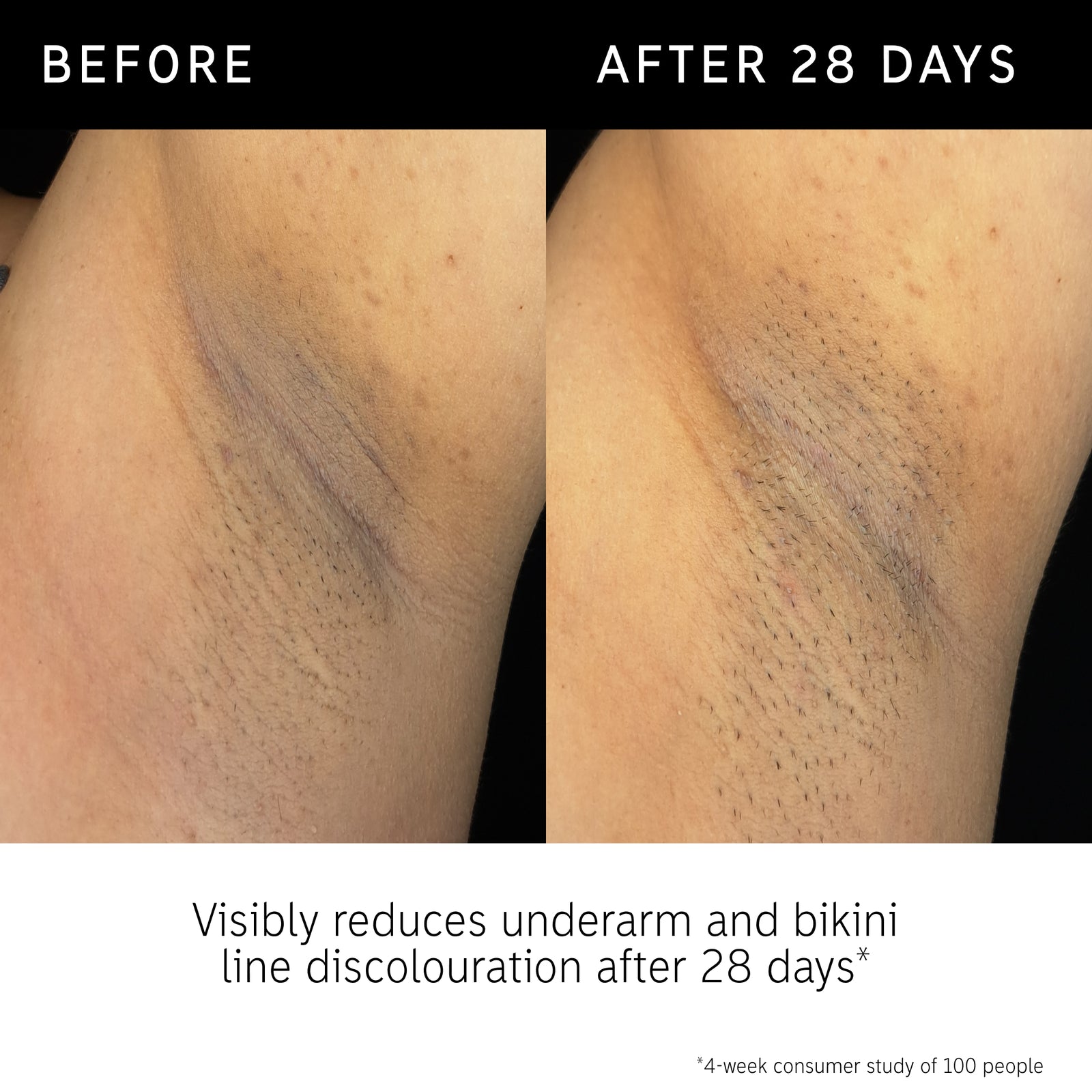 Before and after using Glycolic Body Stick for 28 days for underarm discolouration