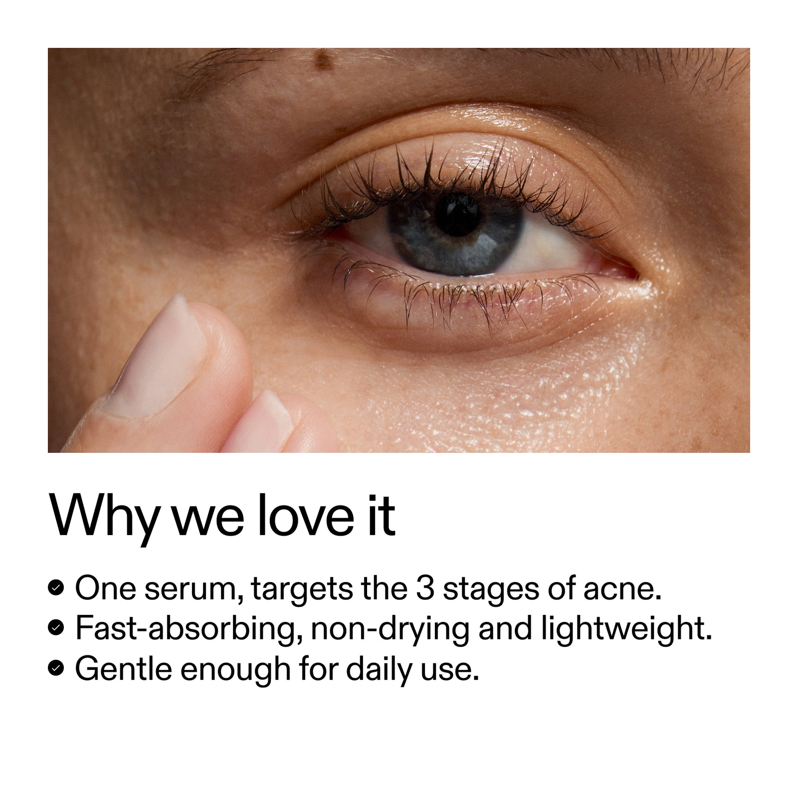 Why we love, one serum to target 3 stages of acne, fast absorbing, non drying and lightweight