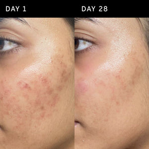 Day 1 vs Day 28, showing reduced redness 