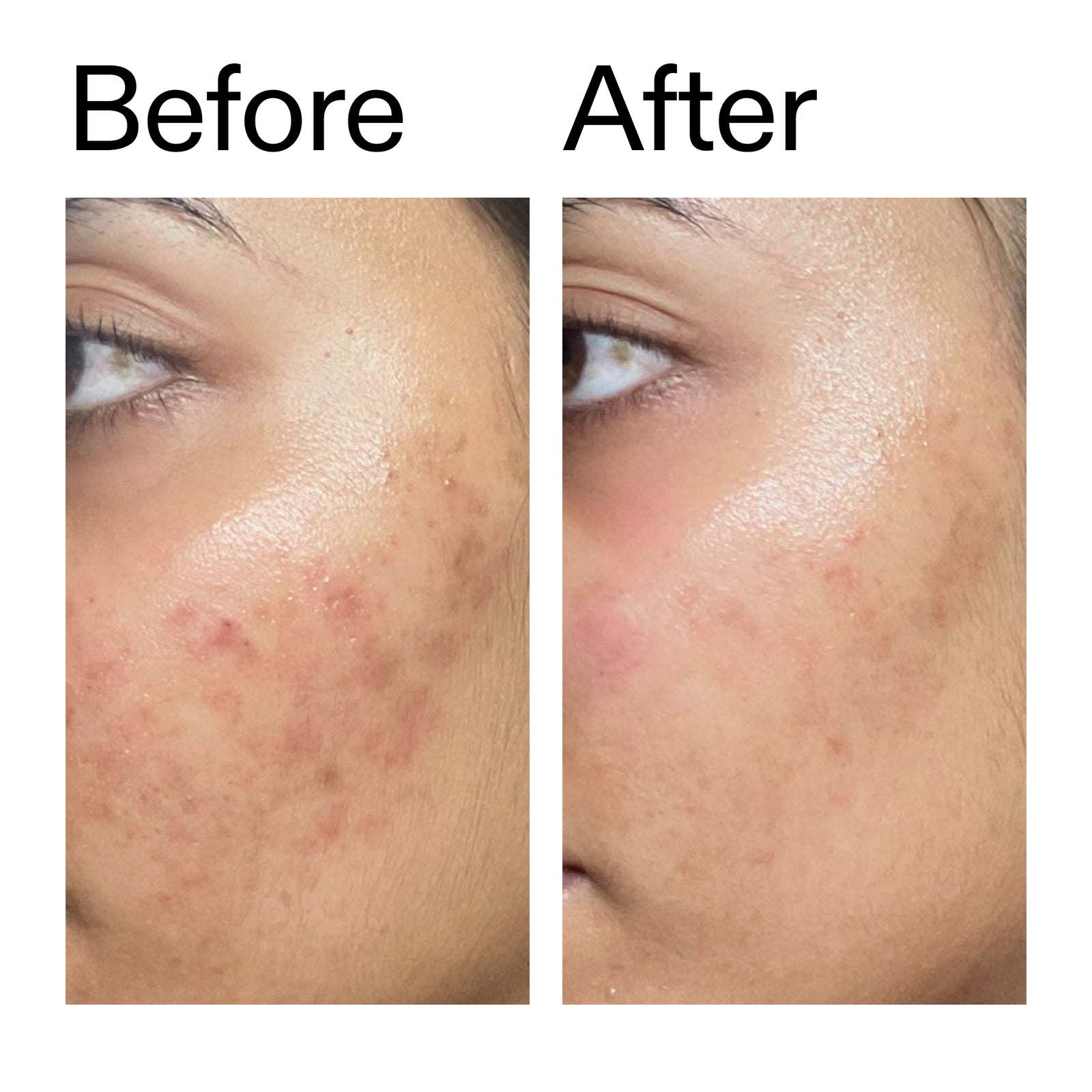 Before and after comparison of a face after using Ectoin Hydro-Barrier Serum