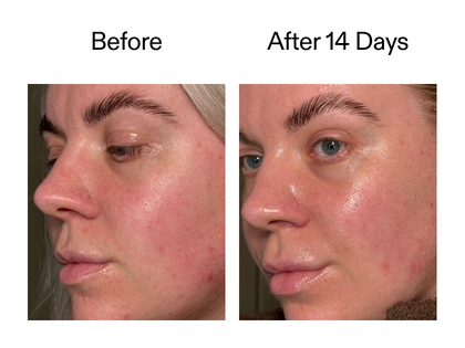 Before and after 14 days using Exosome serum