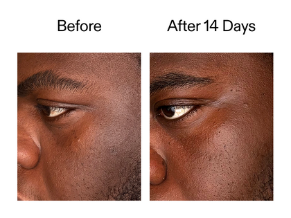 Before and after 14 days using Exosome serum