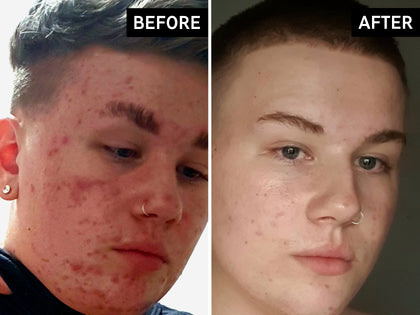 Before and after comparison of a person's face with acne treatment.