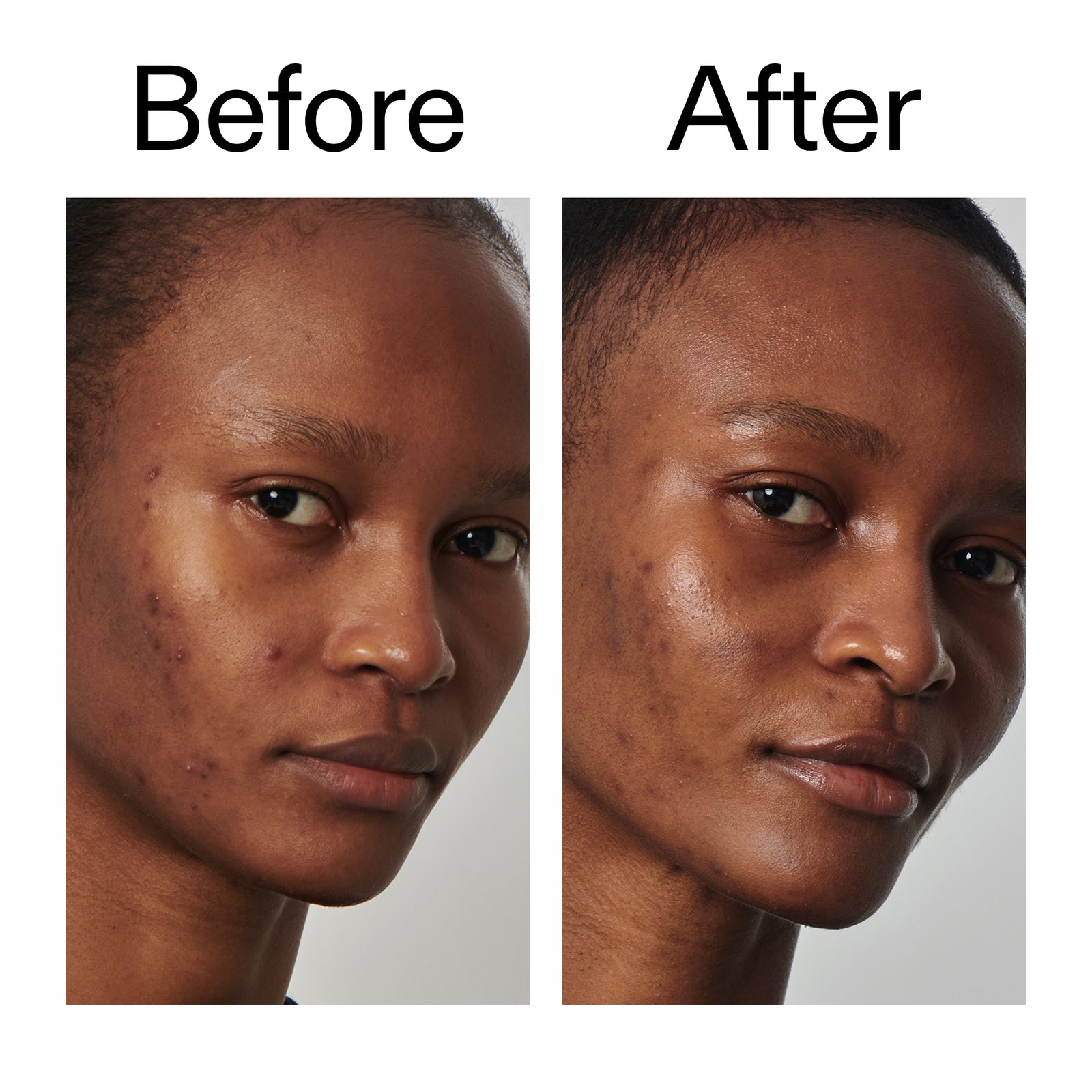 Before and after comparison of a person's face with visible skin texture changes.