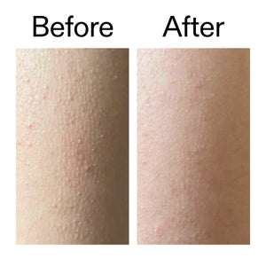 Before and after comparison of someone using Glycolic Acid Exfoliating Body Stick on the KP bumps