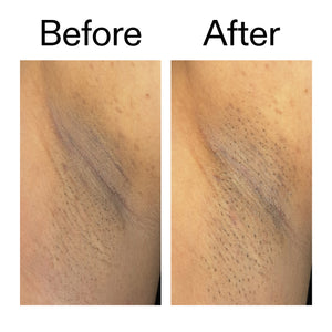 Before and after comparison of someone using Glycolic Acid Exfoliating Body Stick on their armpit