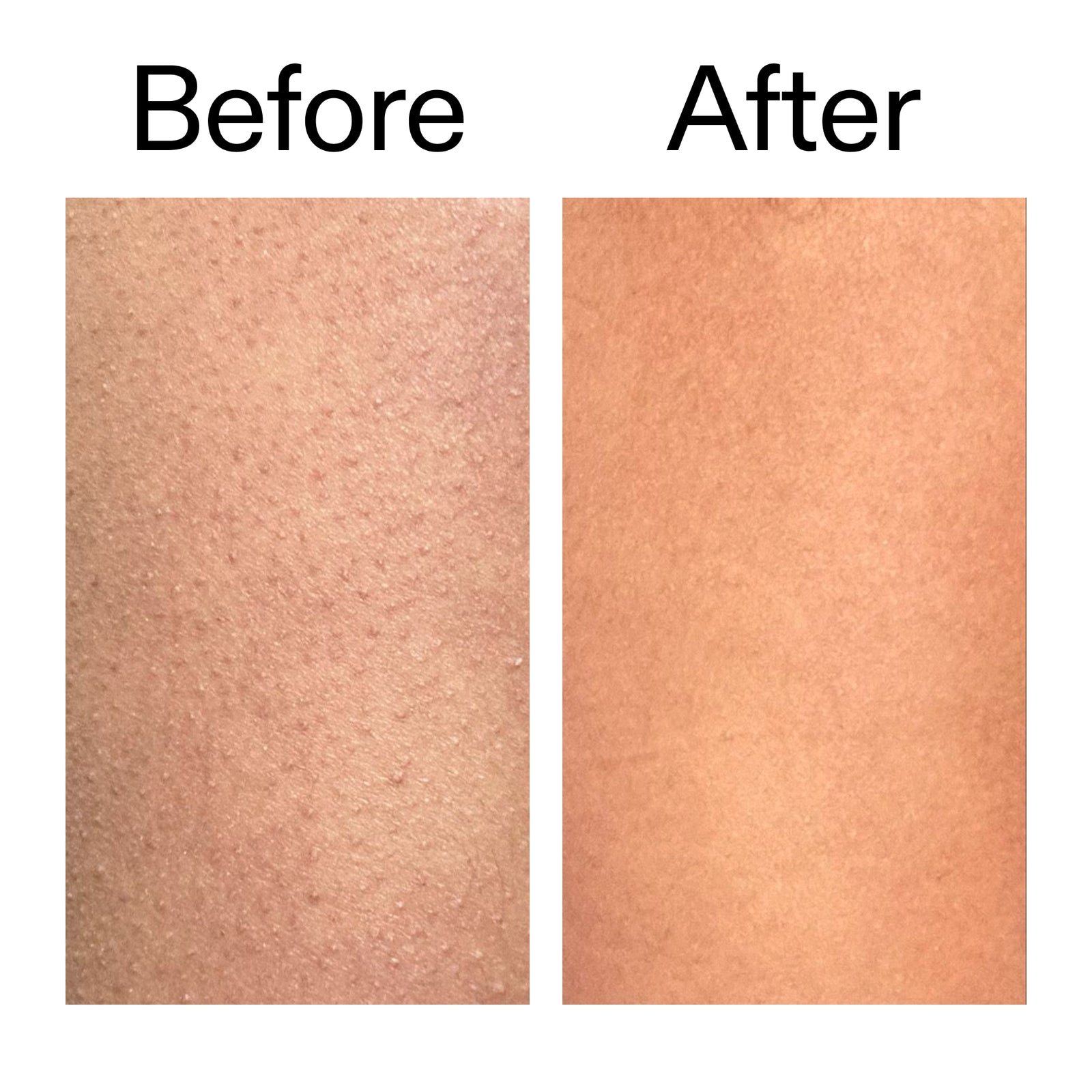 Before and after comparison of skin texture with 'Before' on the left and 'After' on the right.