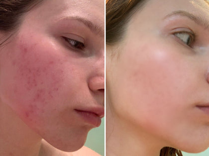 Before & After using Hyaluronic Acid Serum