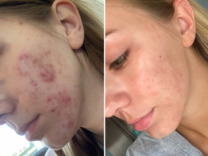 Before & After using Hyaluronic Acid Serum