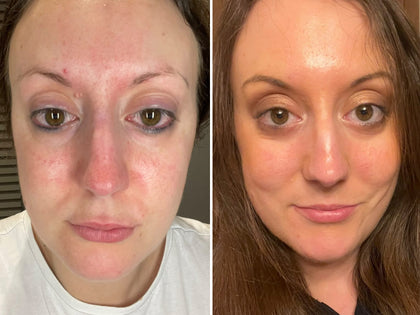 Before & After using Hyaluronic Acid Serum