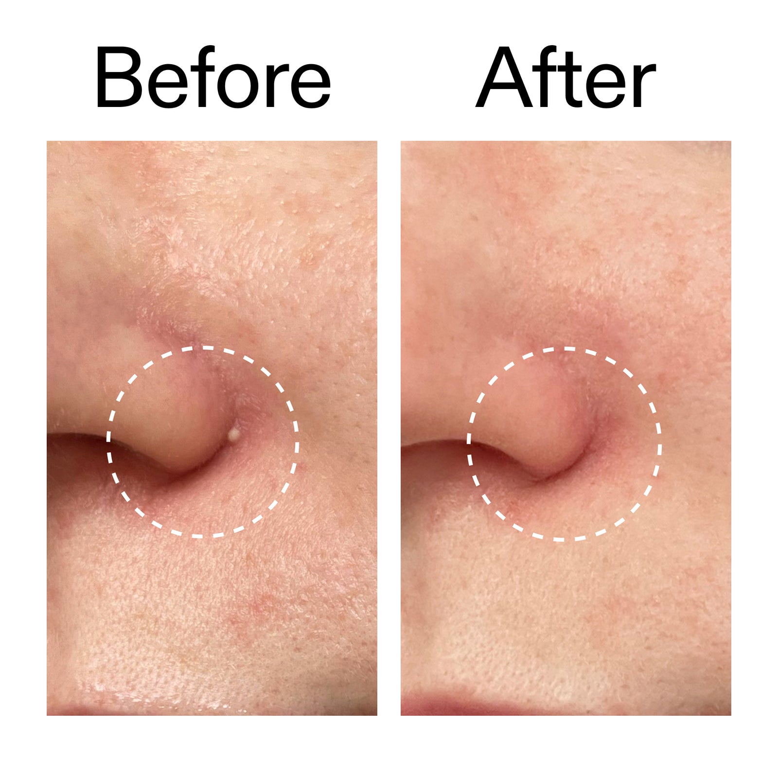 Before and after using Hydrocolloid Invisible Patches