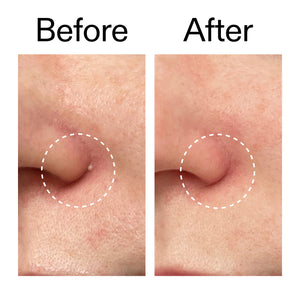 Before and after using Hydrocolloid Invisible Patches