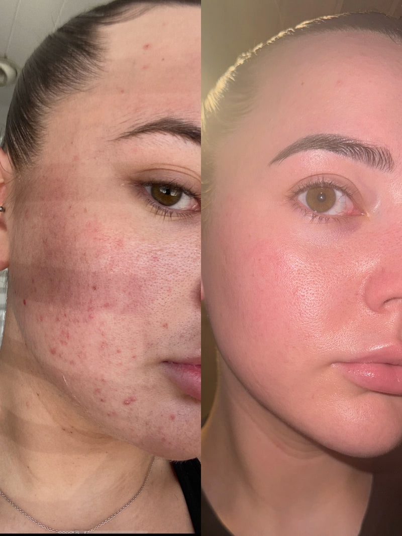 A close-up before-and-after split screen showing a woman's face, with the left side displaying active acne and blemishes and the right side showing a clearer, smoother complexion.